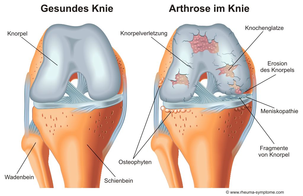 Arthrose im Kniegelenk Arthrose im Kniegelenk