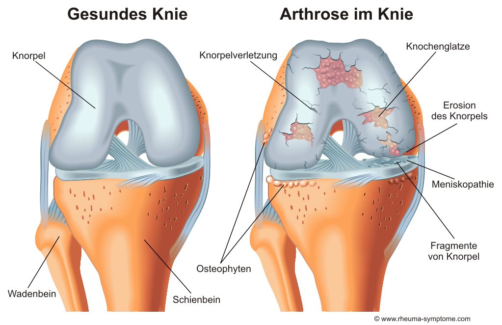 Arthrose im Kniegelenk