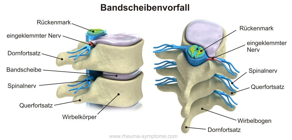 Bandscheibenvorfall