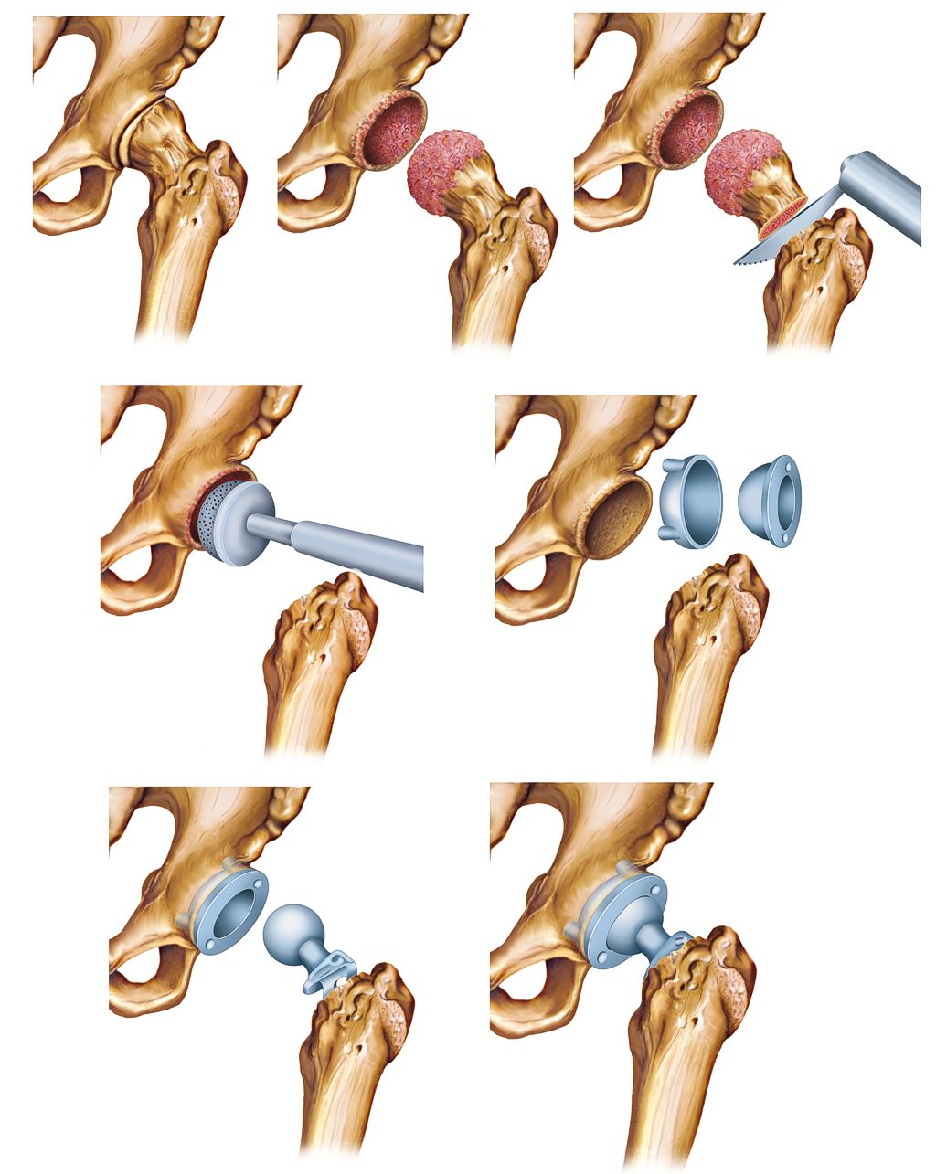 Ein Gelenkersatz bei Arthrose Der künstliche Gelenkersatz bei Arthrose
