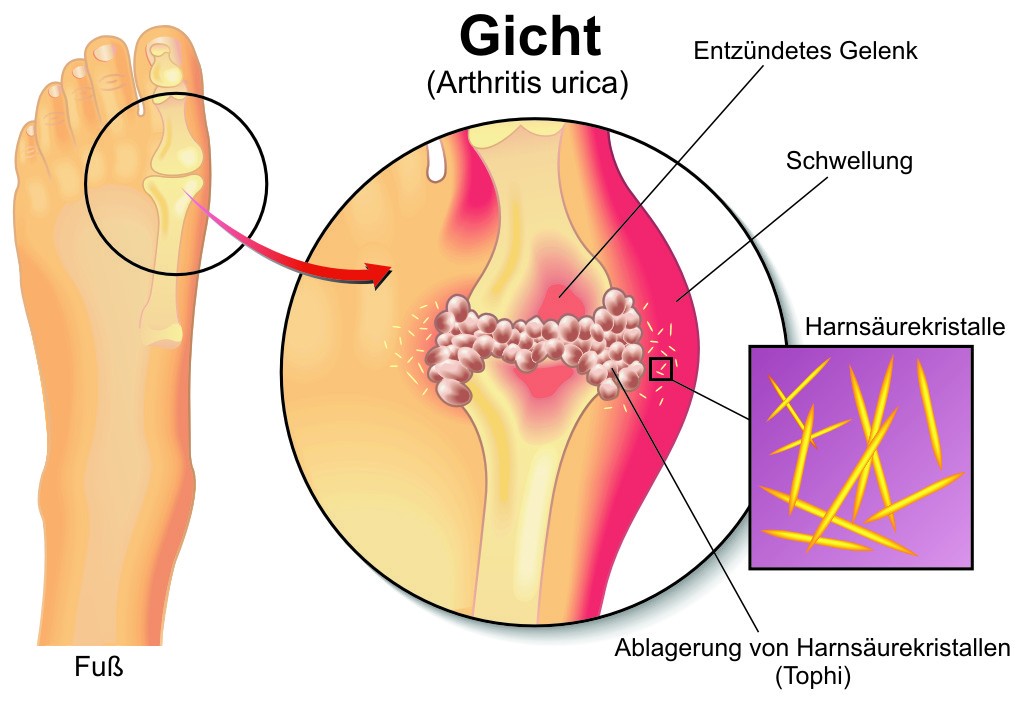 Gicht - Harnsäurekristalle lagern sich im Fuß ab