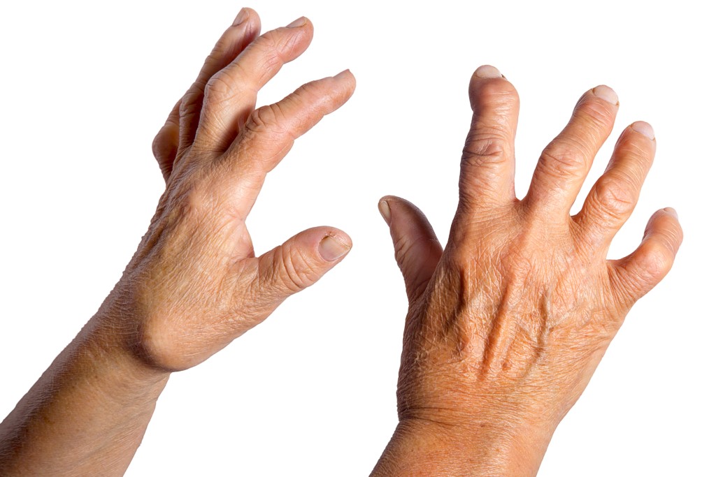 Hände mit rheumatoider Arthritis