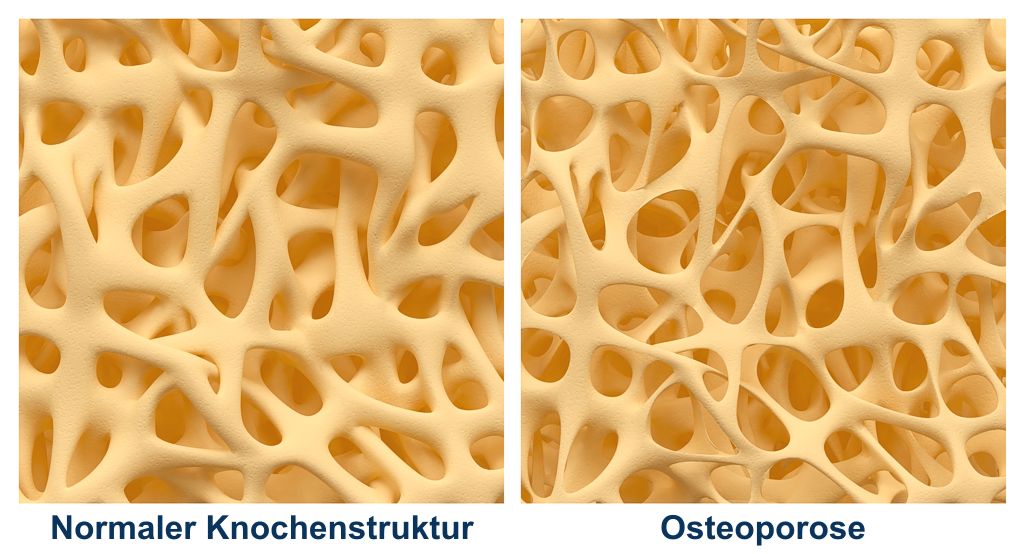 Osteoporose Knochenschwund