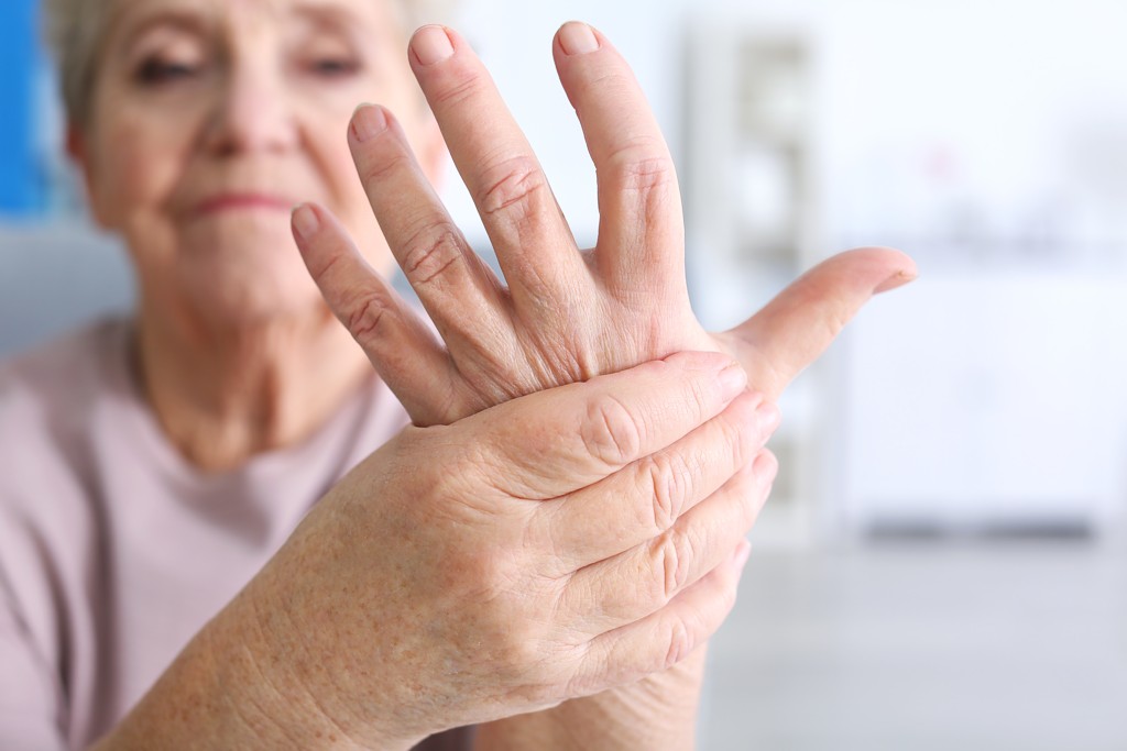 Ältere Frau zeigt Hand - Sie leidet an rheumatoiden Arthritis