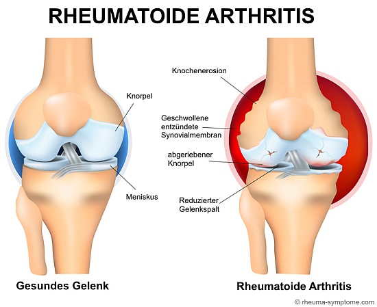 Gelenk bei rheumatoider Arthritis